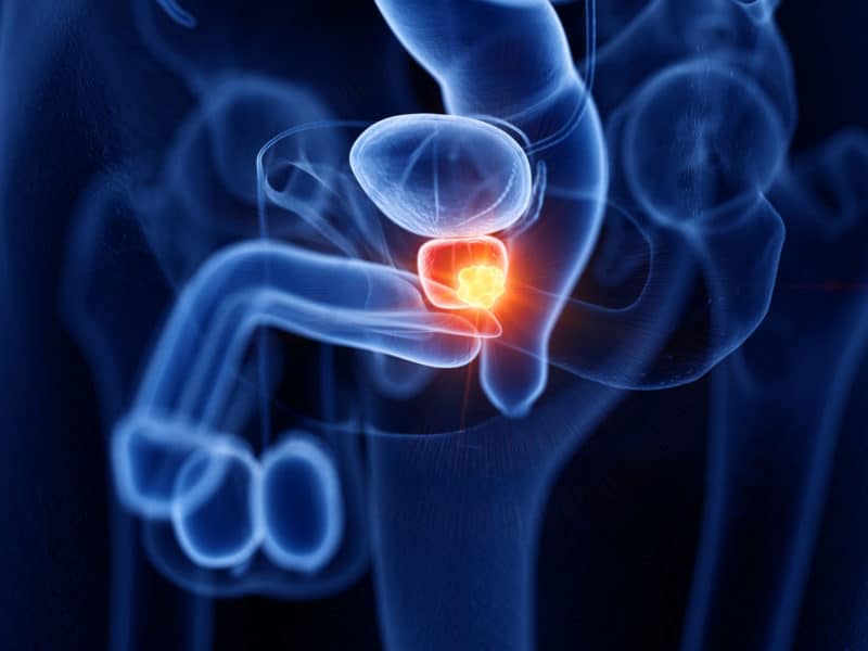 prostate cancer test in London - Echelon Health