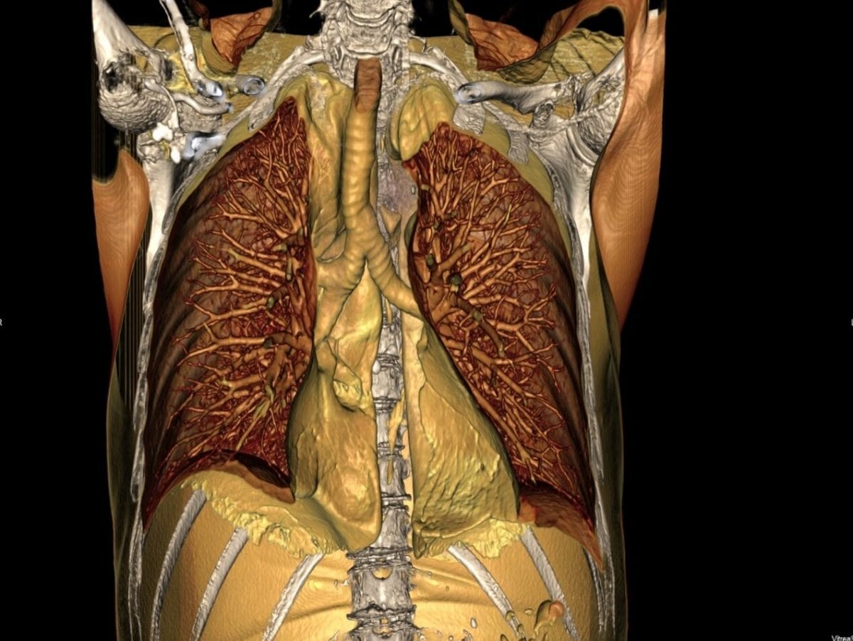 CoreCancerCasestudy CoreCancerCasestudy